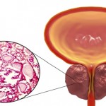 علاج مبتكر لتضخم البروستات دون الإضرار بالخلايا السليمة!
