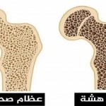 طرق الوقاية من هشاشة العظام