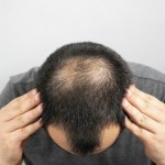 اكتشاف السبب الدقيق لتساقط الشعر ما يعد بعلاجات جديدة للصلع