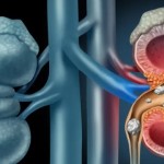 بينها خل التفاح.. علاجات طبيعية قد تخلصك من حصوات الكلى
