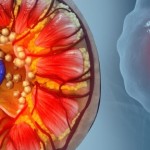 دراسة تفجر مفاجأة عن السبب الحقيقي لتكون حصوات الكلى