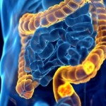 اكتشاف طريقة واعدة لإبطاء سرطان القولون وزيادة فرص النجاة