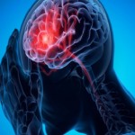 عامل خطر غير متوقع للجلطة الدماغية