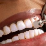 وداعاً للتسوس.. جل جديد يُعيد بناء مينا الأسنان